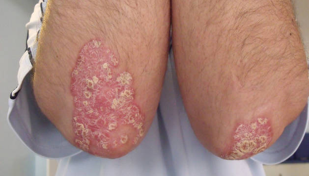 La psoriasis en las extremidades